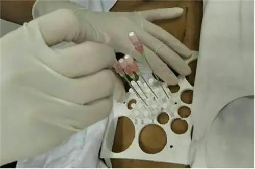 一文读懂放射性粒子植入治疗肿瘤