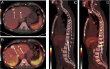 揭秘极光PET/CT，Biograph Vision Quadra PSMA + FDG 双显像新探索